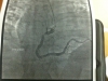 Pre Stent